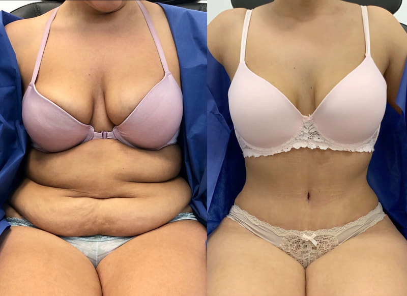 tummy tuck  - before & after 19