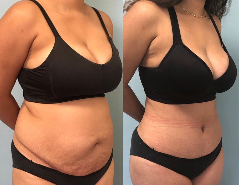 tummy tuck  - before & after 21