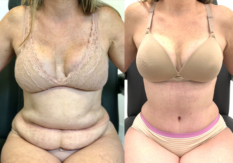 tummy tuck  - before & after 24