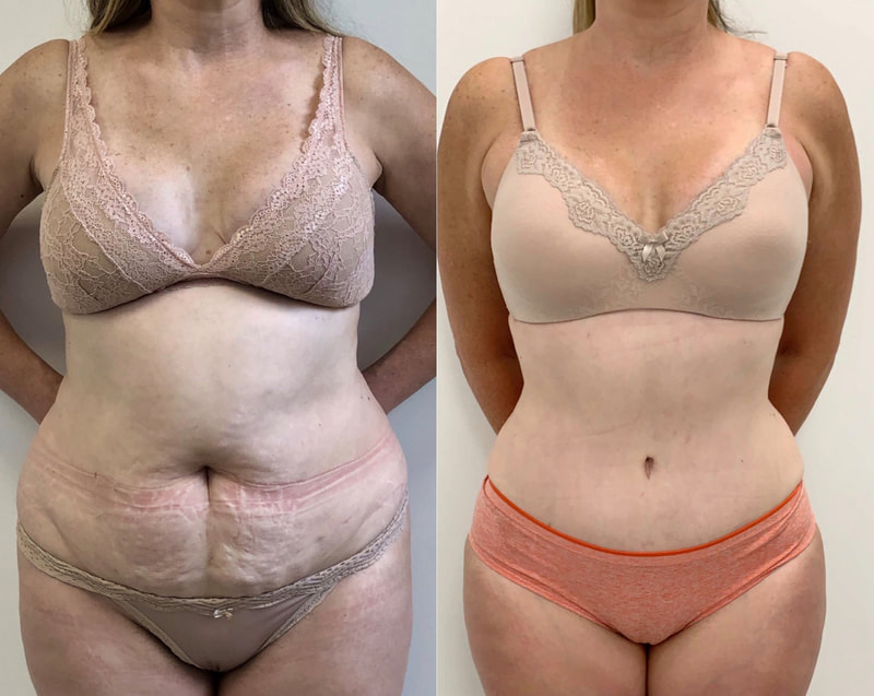 tummy tuck  - before & after 25