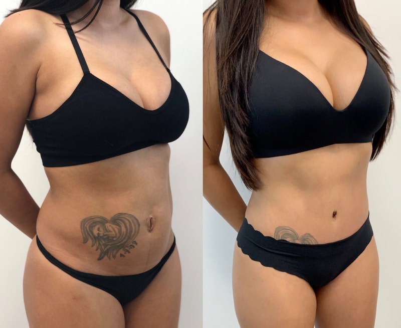 tummy tuck  - before & after 29