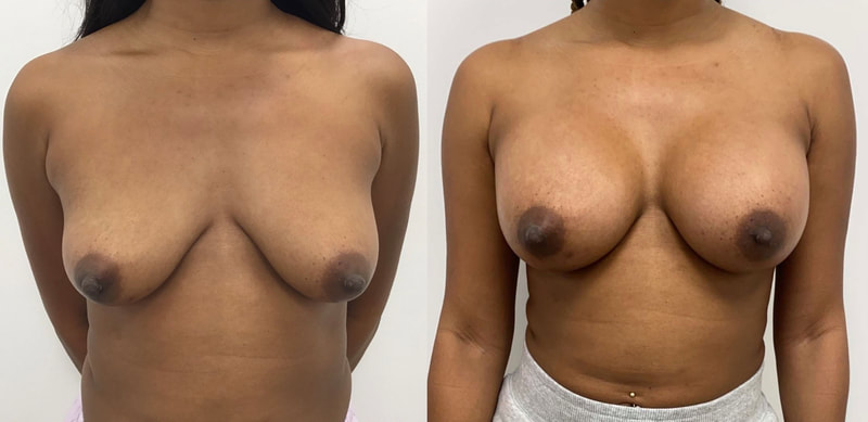 Breast implant before & after 112