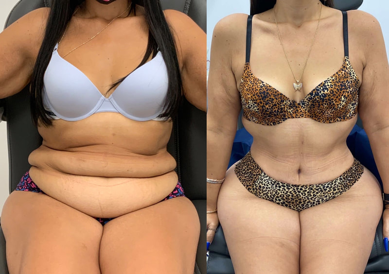 tummy tuck  - before & after 116
