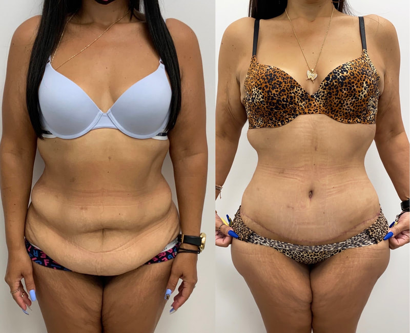 tummy tuck  - before & after 118