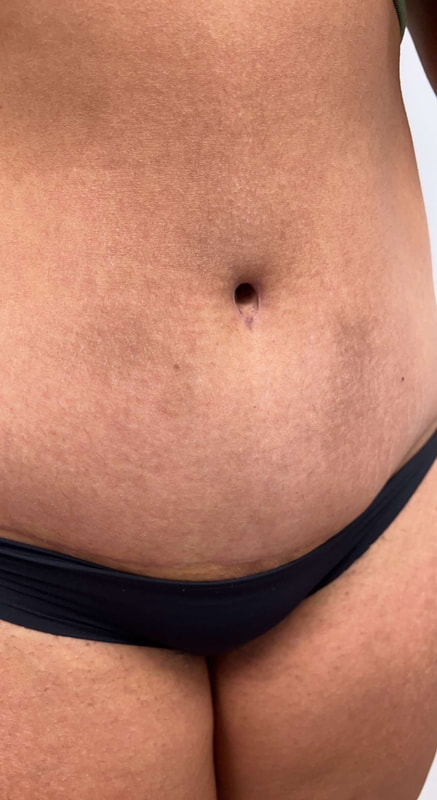 Dr. Oppenheimer - Belly Button After Tummy Tuck
