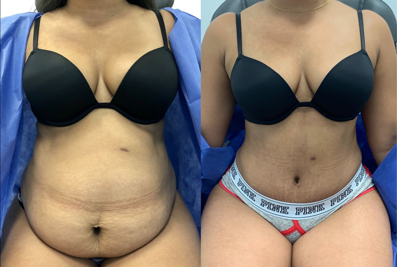 tummy tuck  - before & after 8