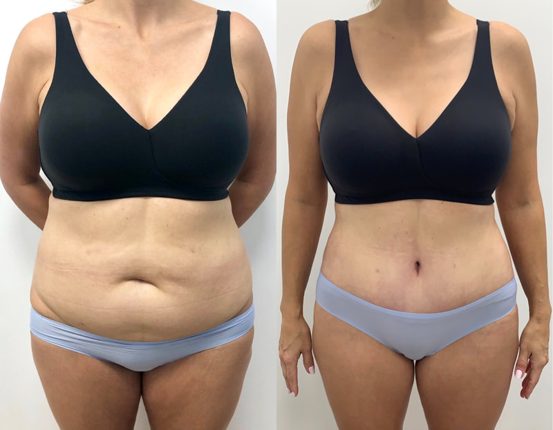 tummy tuck  - before & after 69
