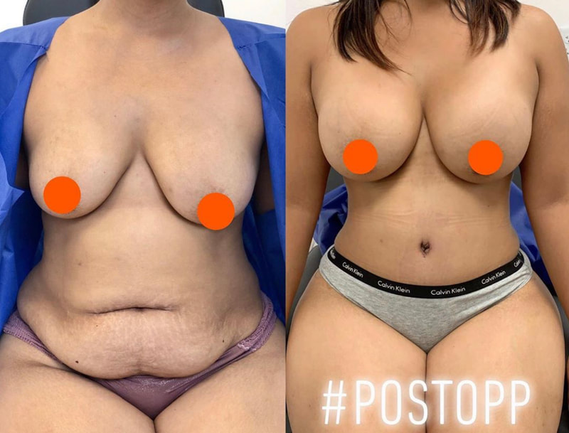 tummy tuck  - before & after 73