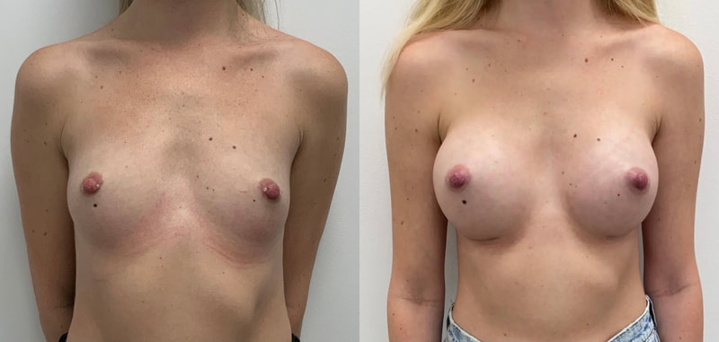 Breast implant before & after 127