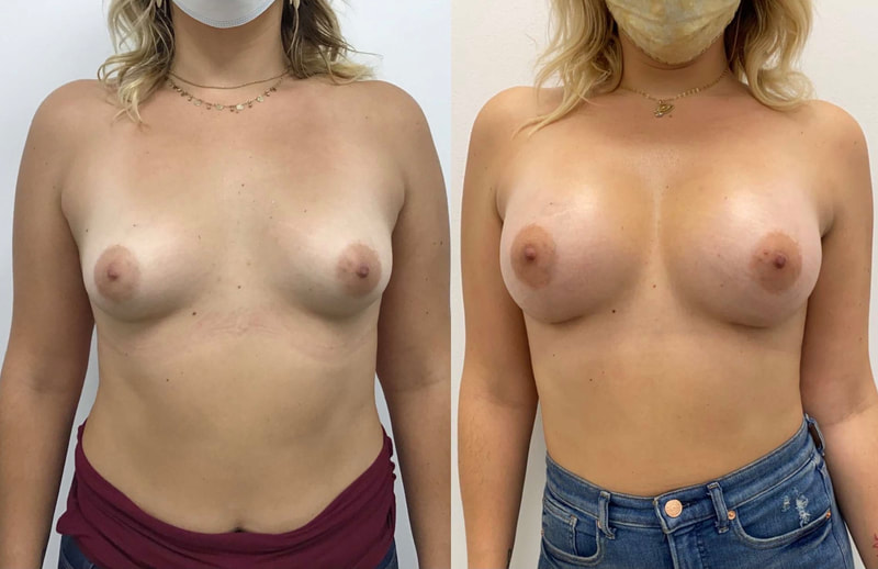 Breast implant before & after 117