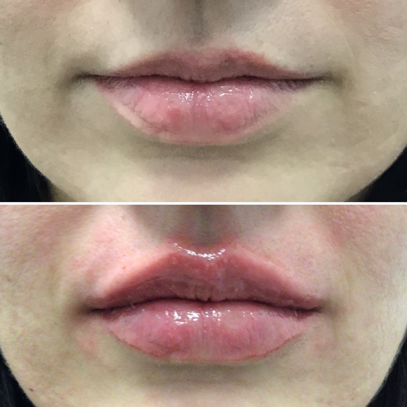 Lip Injection - Before & After 15