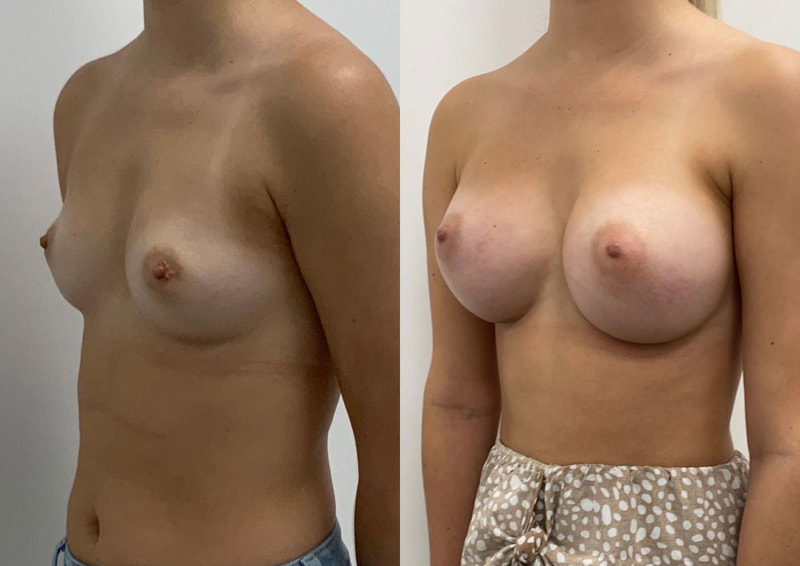 Breast implant before & after 116