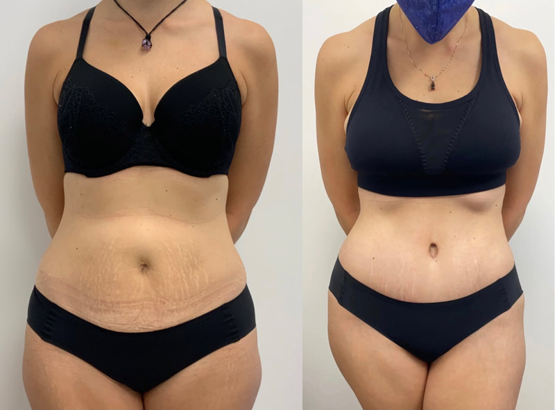 tummy tuck  - before & after 138