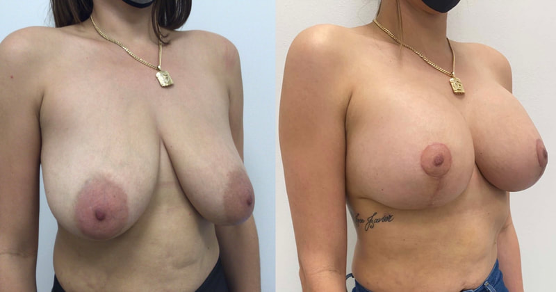 Breast implant before & after 124