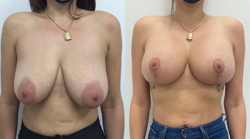 Breast implant before & after 123