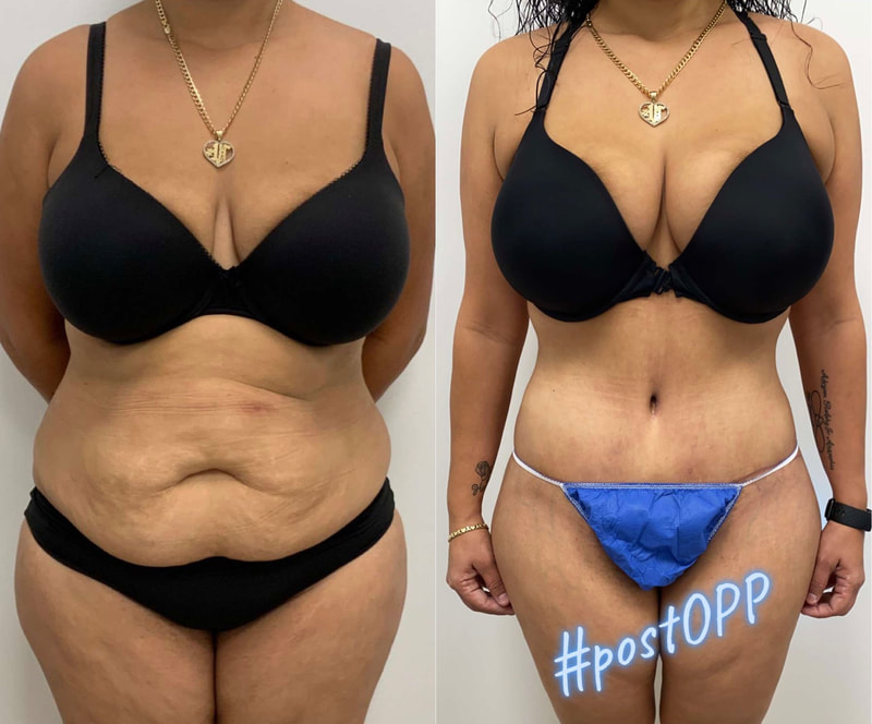 tummy tuck  - before & after 124