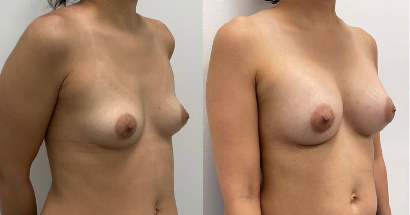 Breast implant before & after 130