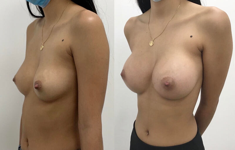 Breast implant before & after 107