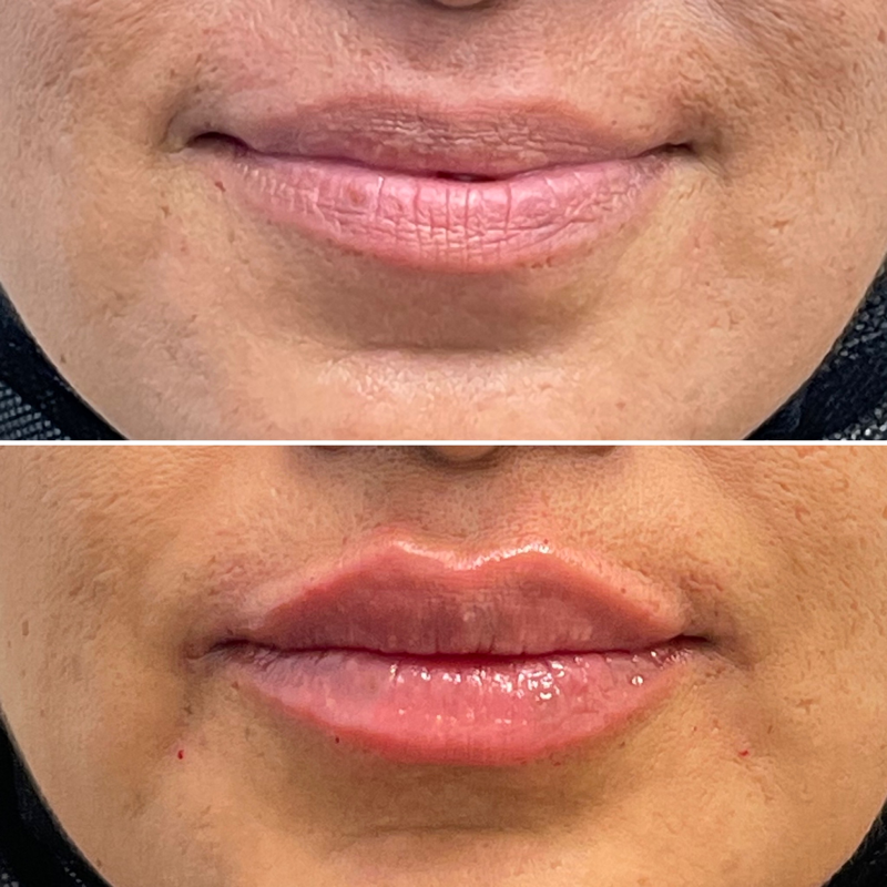 Lip Injection - Before & After 19