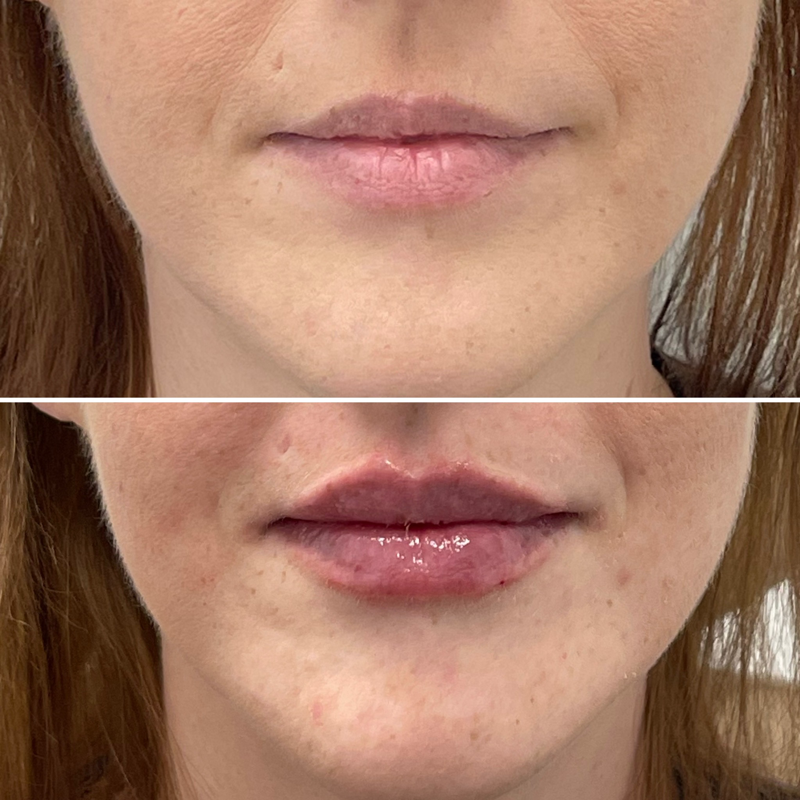 Lip Injection - Before & After 24