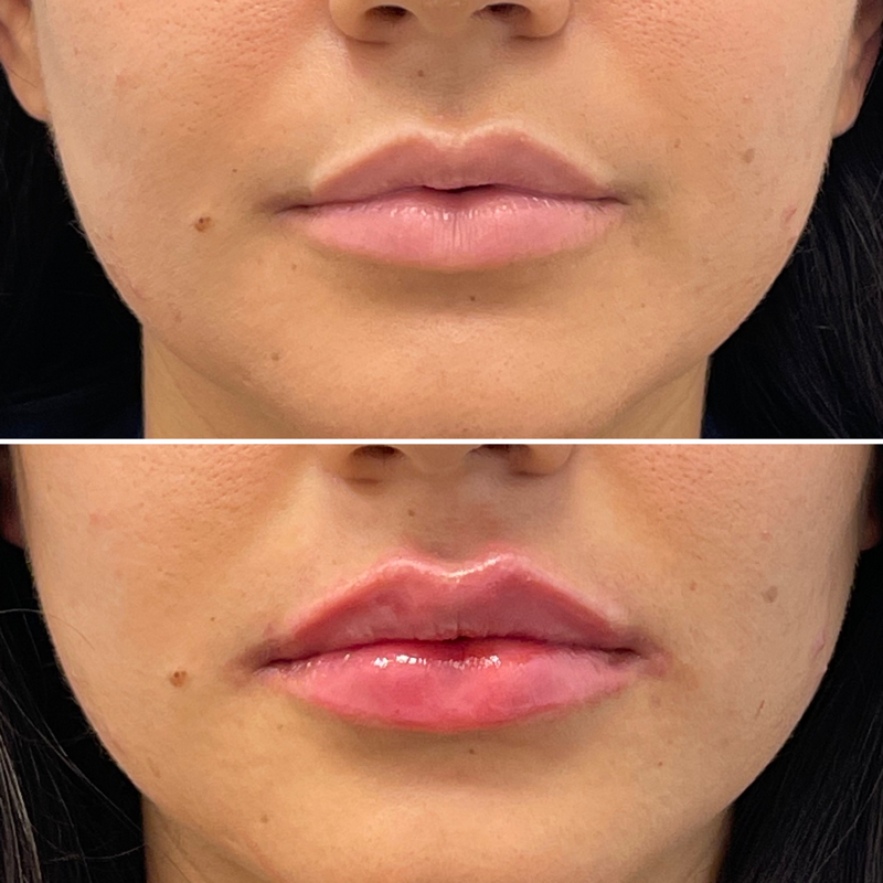 Lip Injection - Before & After 22