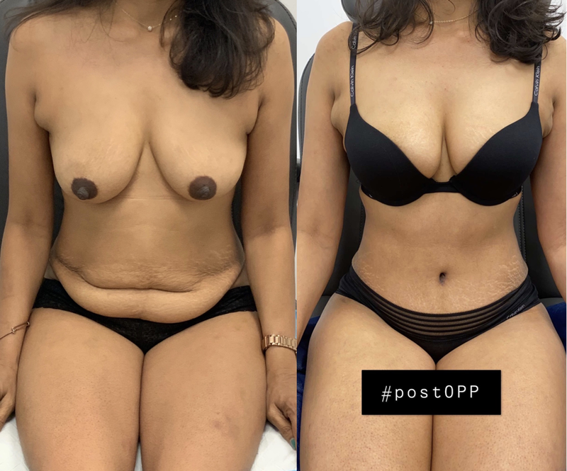 tummy tuck  - before & after 114