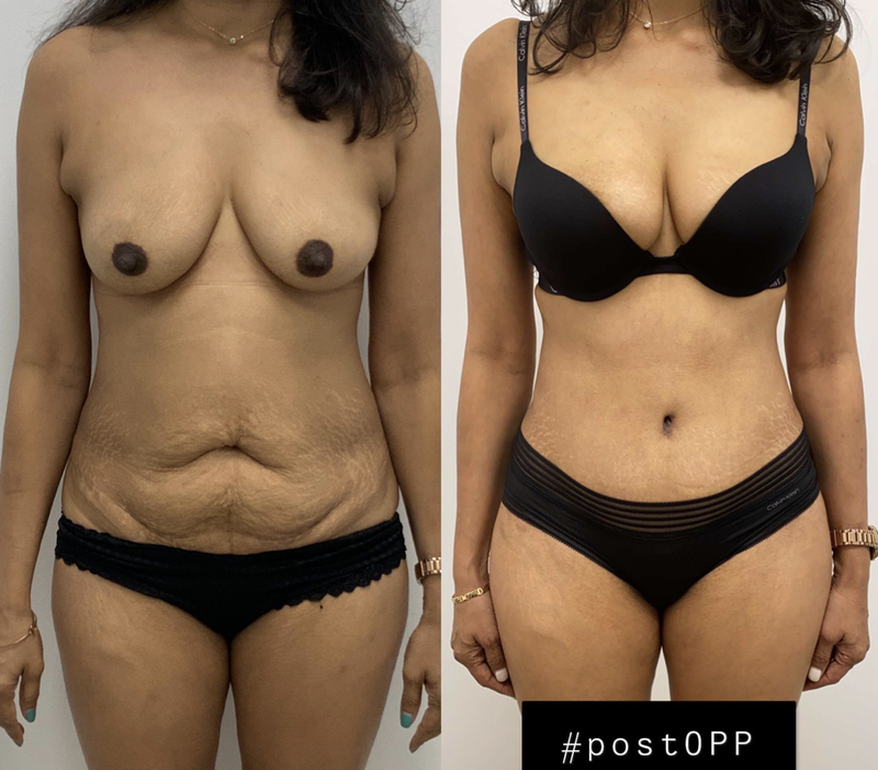 tummy tuck  - before & after 115