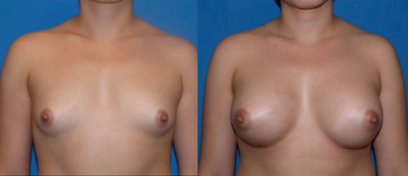 Breast implant before & after 10