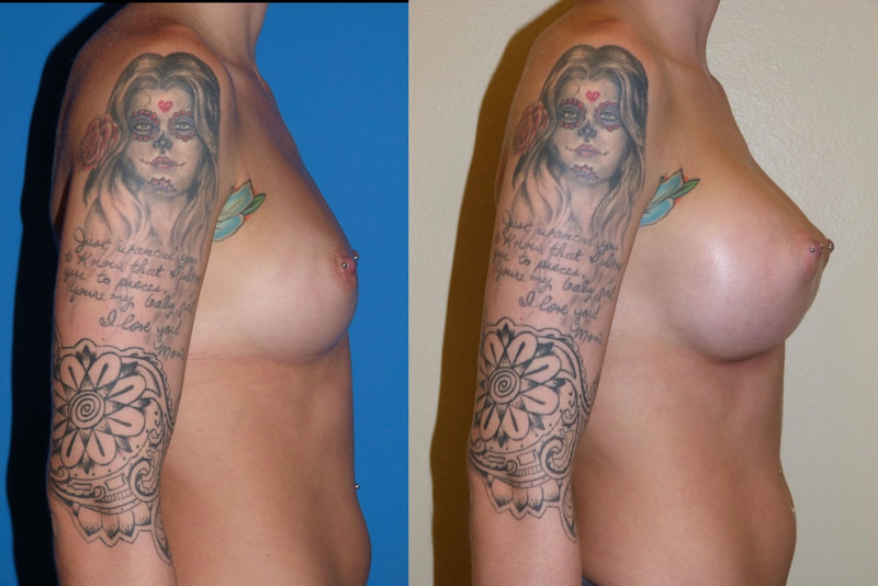Breast implant before & after 20
