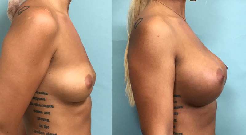 Breast implant before & after 25
