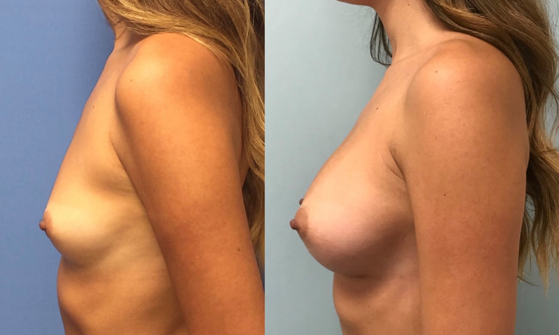 Breast implant before & after 3