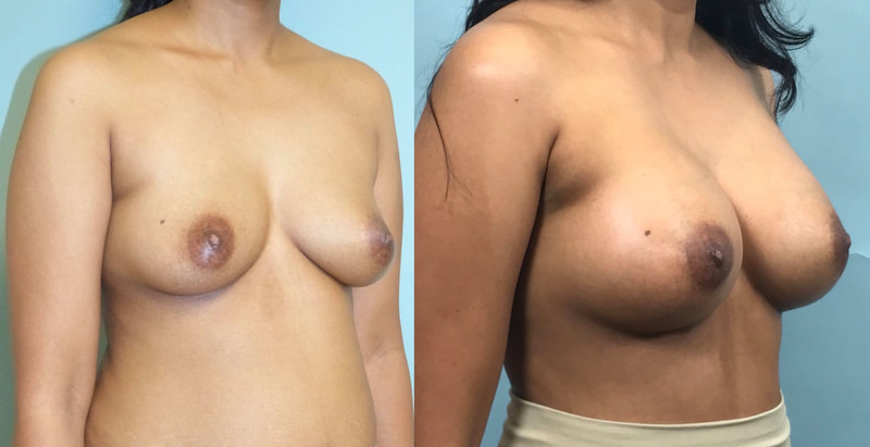 Breast implant before & after 32