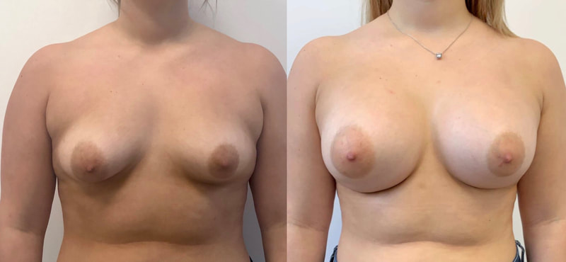 Breast implant before & after 36