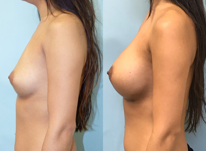 Breast implant before & after 72
