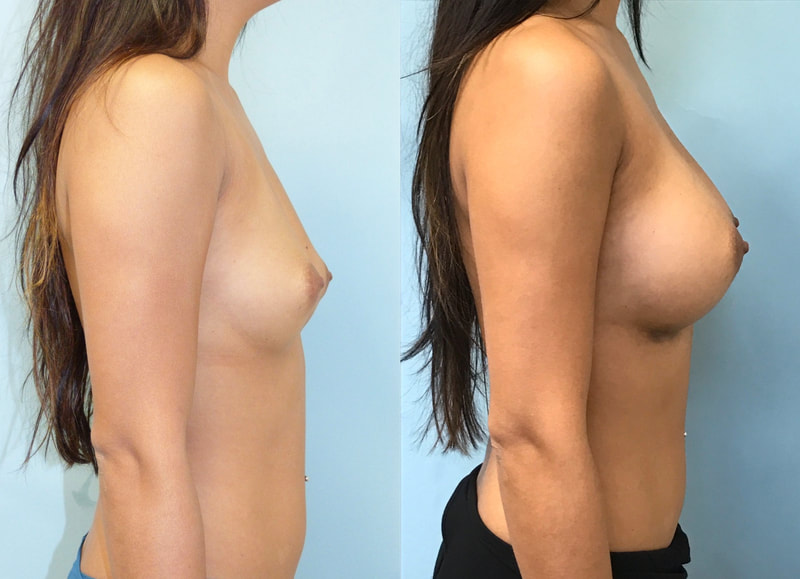 Breast implant before & after 75