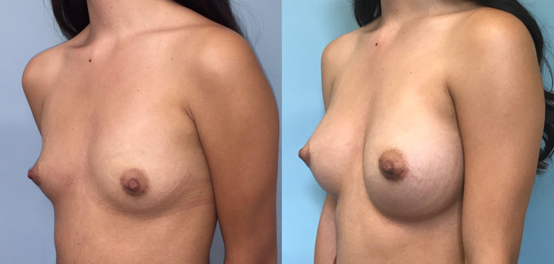 Breast implant before & after 79