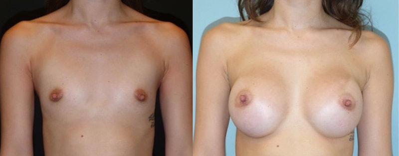 Breast implant before & after 83