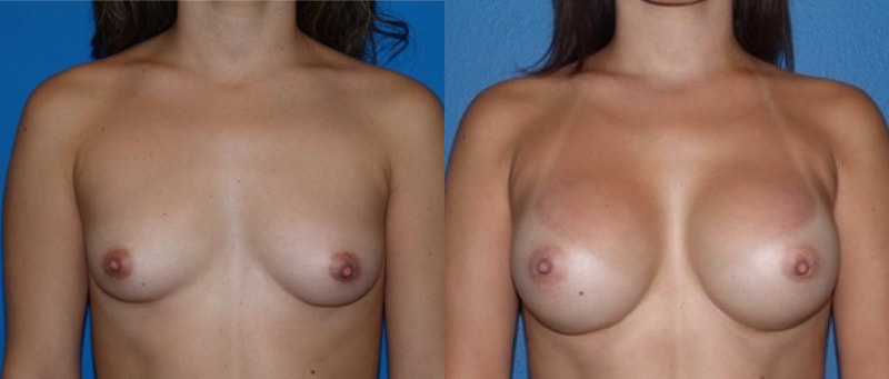 Breast implant before & after 88