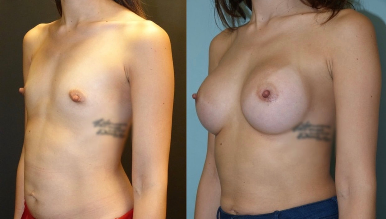 Breast implant before & after 92