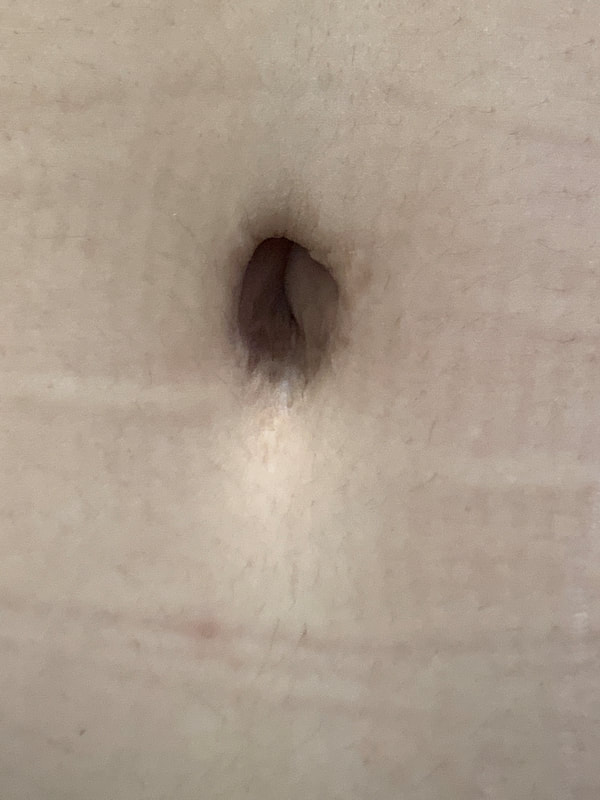 Post Opp - Belly Button Sample Image