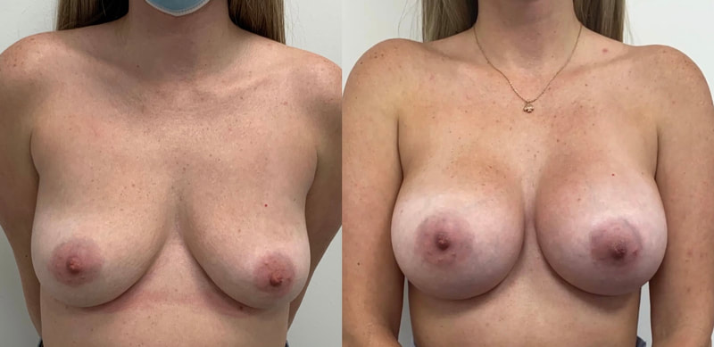 Breast implant before & after 133