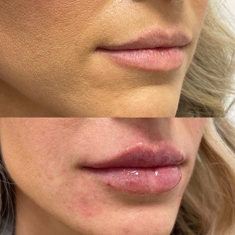 Lip Injection - Before & After 8