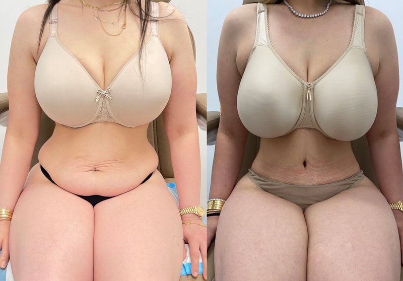 tummy tuck  - before & after 150
