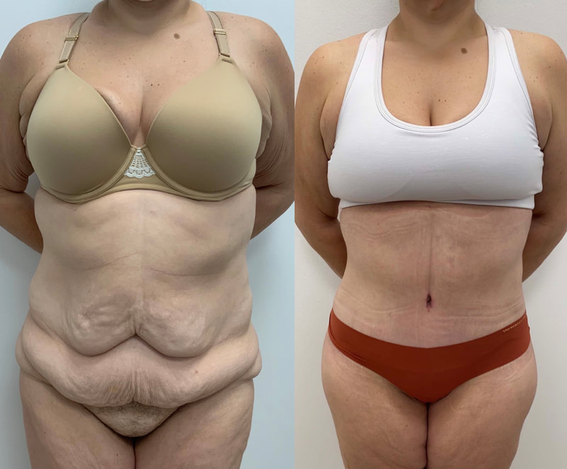 tummy tuck  - before & after 145