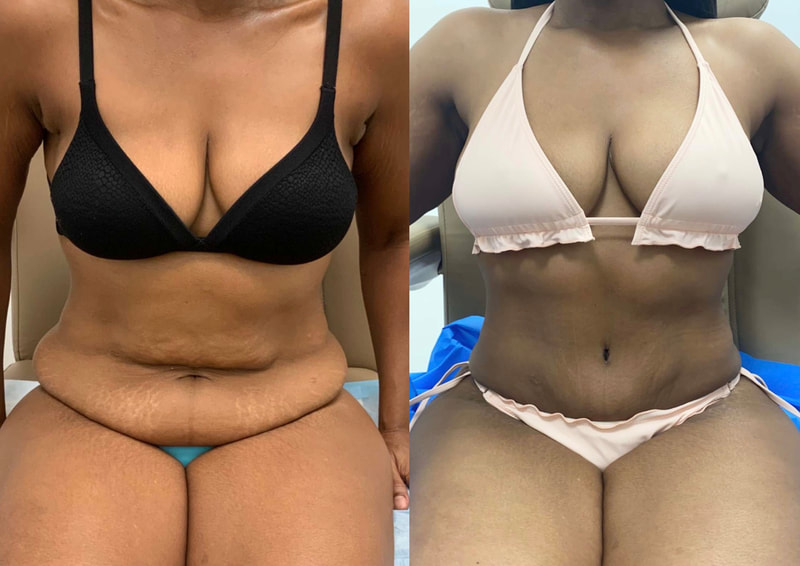 tummy tuck  - before & after 135