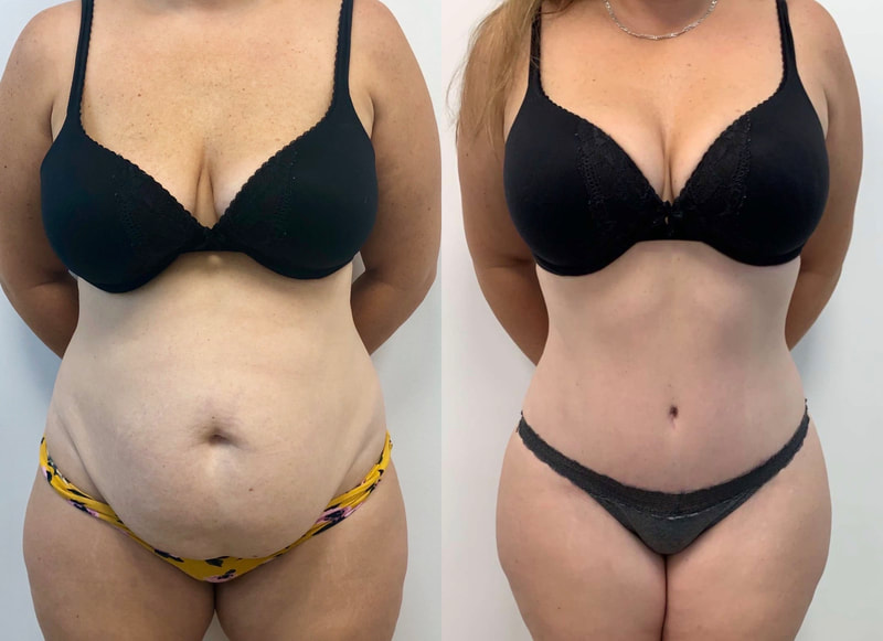 tummy tuck  - before & after 1