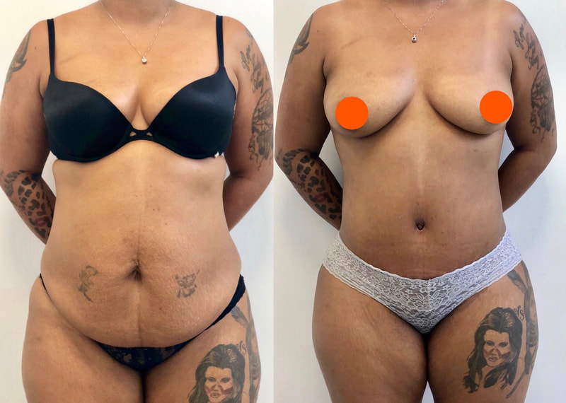tummy tuck  - before & after 15