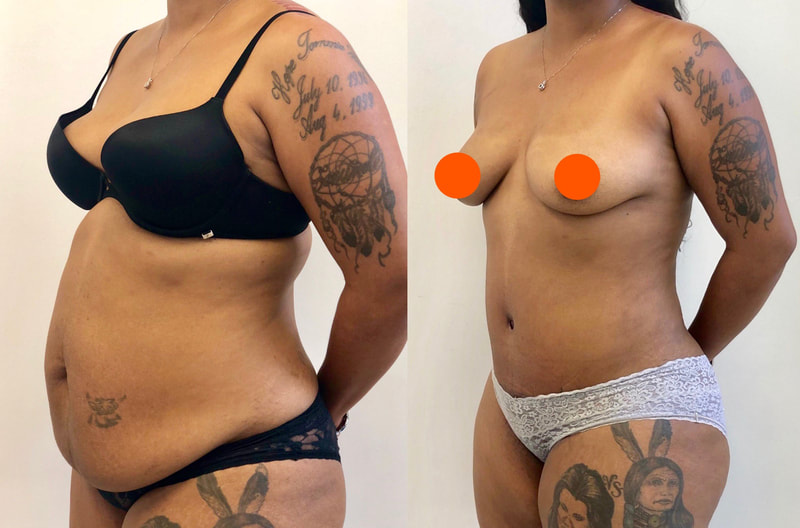tummy tuck  - before & after 16