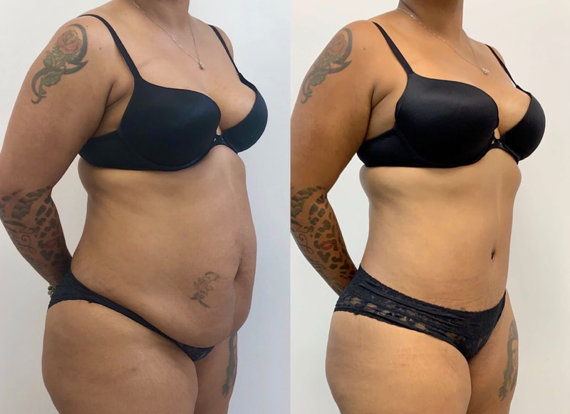 tummy tuck  - before & after 17