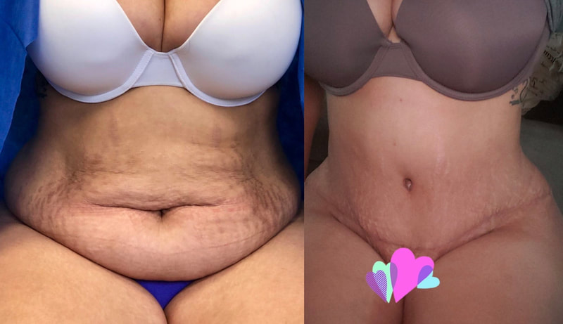 tummy tuck  - before & after 18